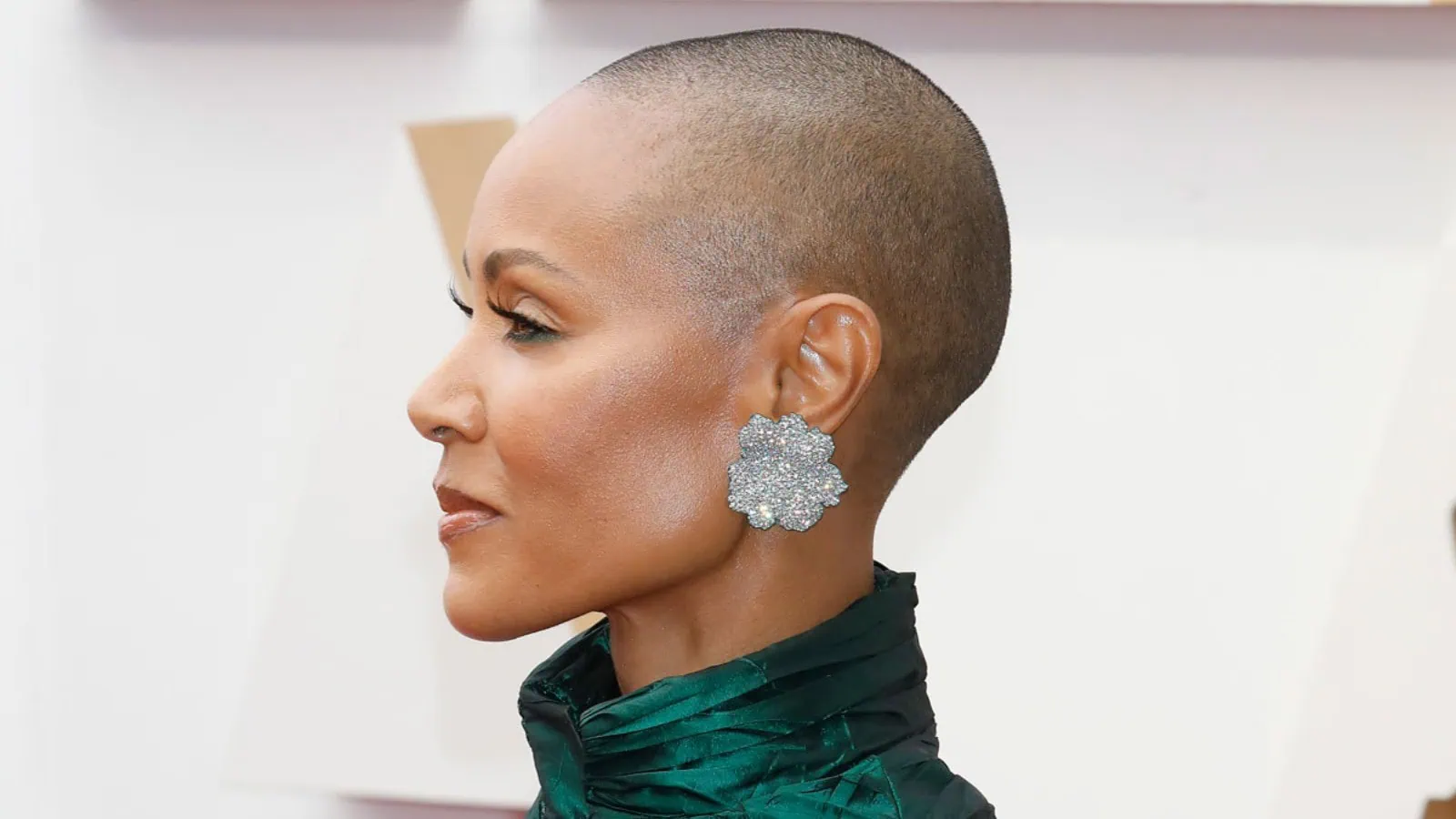 Kenali apa itu alopecia, penyakit jada pinkett-smith