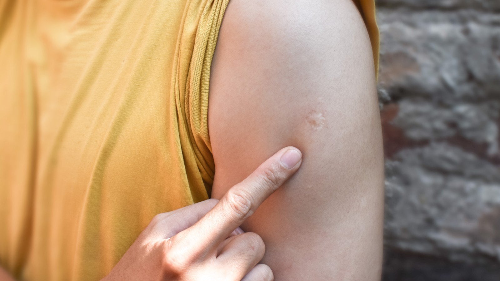 A imagem mostra uma marca da vacina bcg no braço
