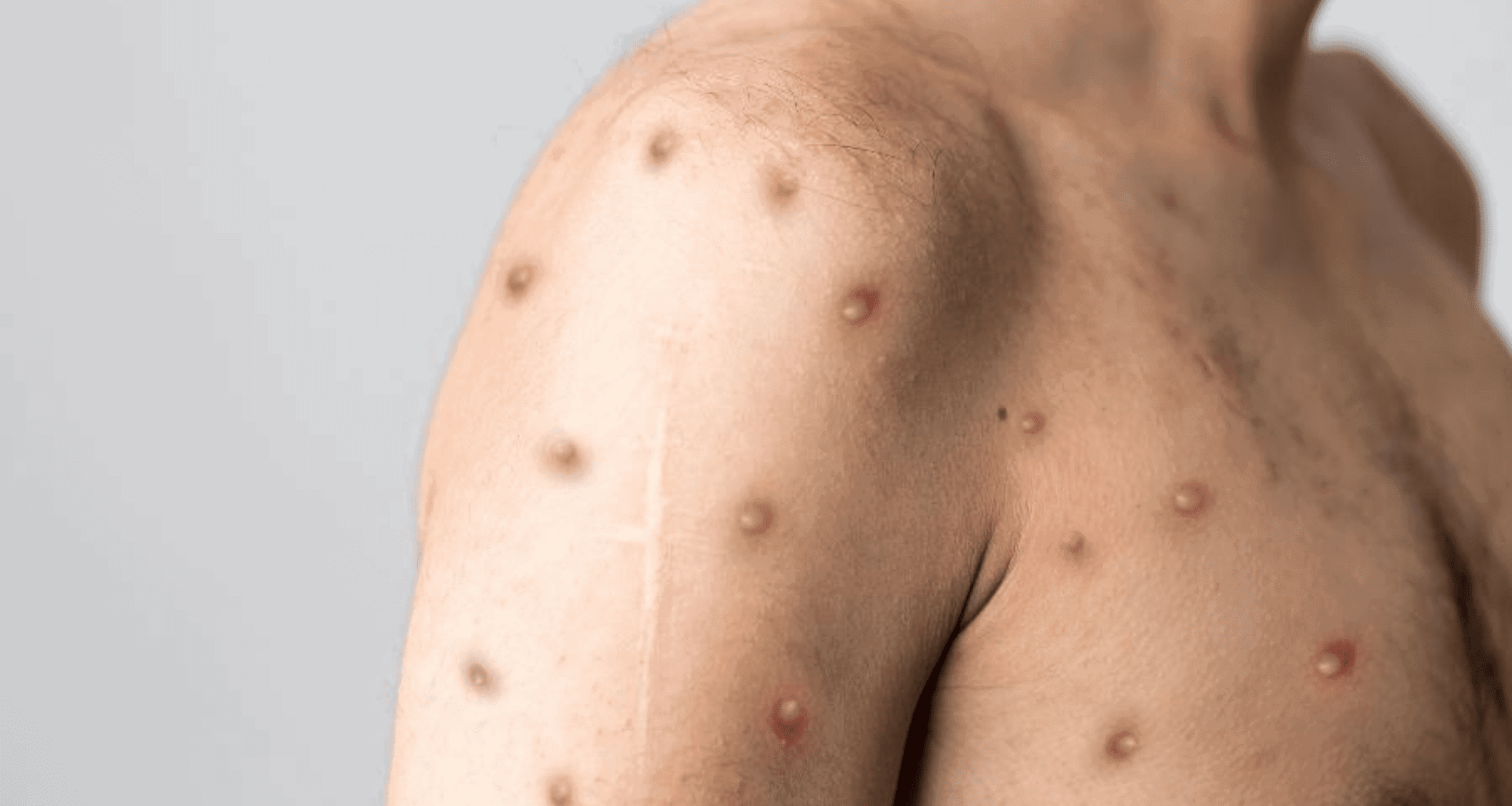 Pessoa com sintomas da varíola do macaco