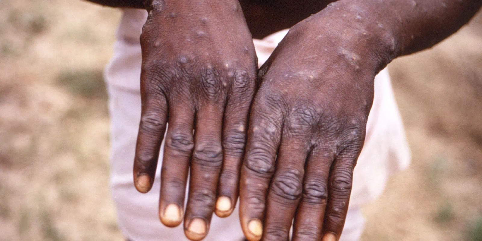 Personne atteinte de monkeypox, qui est maintenant une urgence mondiale selon l'OMS