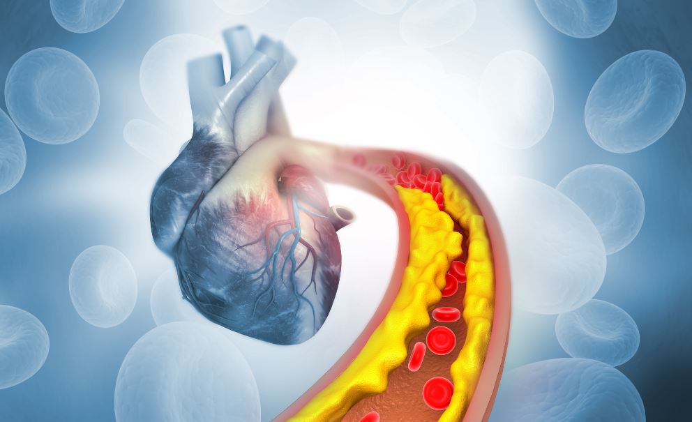 Coração de pessoa que não passou por tratamento de colesterol e precisa de edição genética