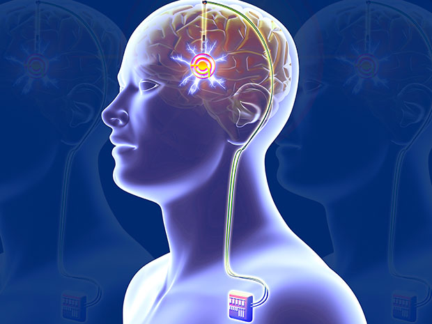 Animação de pessoa com eletrodos no cérebro para o tratamento de doenças
