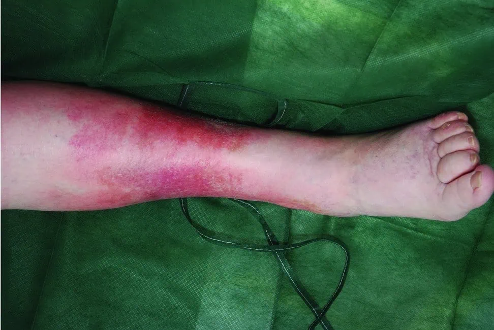 O que é erispela? Entenda a doença de jair bolsonaro Foto de uma pessoa diagnosticada com erispela