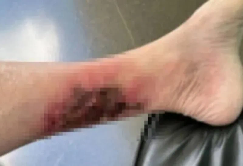 O que é erispela? Entenda a doença de jair bolsonaro Foto borrada da perna de jair bolsonaro com erispela