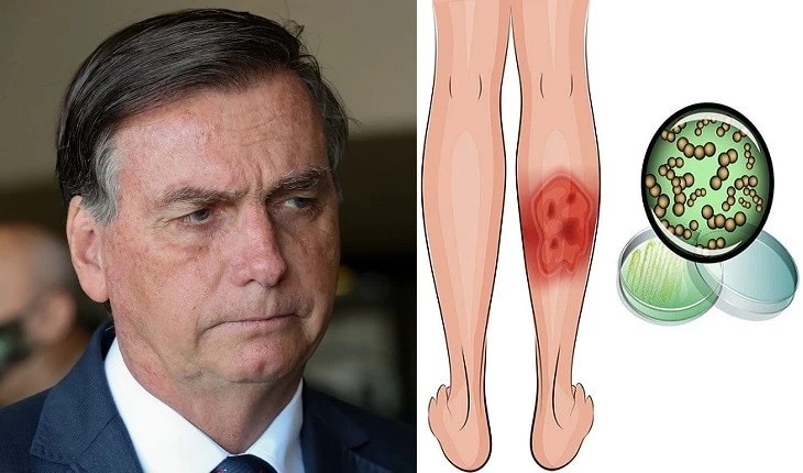 O que é erispela? Entenda a doença de jair bolsonaro Foto de jair bolsonaro ao lado de uma animação com sintomas da erispela