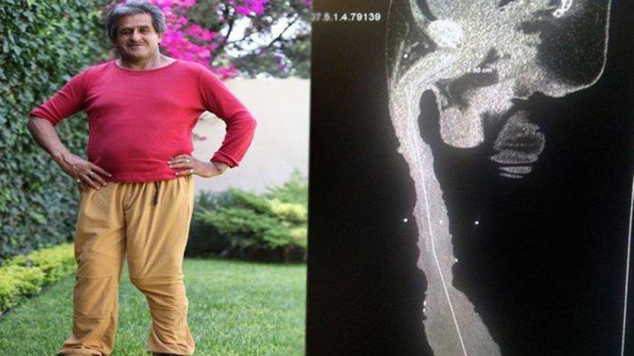 Roberto ao lado de um raio-x de seu pênis, provando que não realizou nenhuma cirurgia para aumentá-lo
