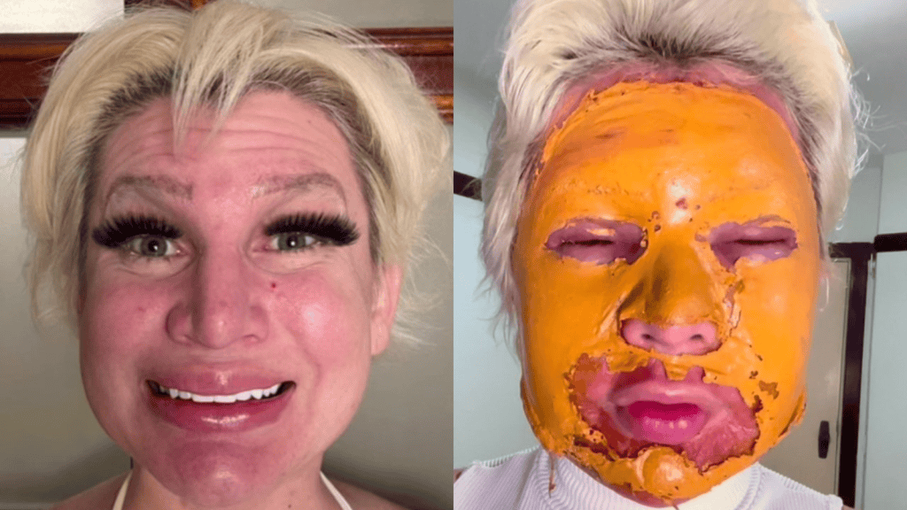 Wat is fenolpeeling? Wat is fenolpeeling? Chemische chirurgietechniek verzacht rimpels en oneffenheden door een oplossing aan te brengen die de huid verbrandt, die vervolgens wordt vernieuwd. Lees meer over de procedure en de gezondheidsrisico's ervan