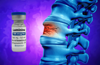 Injeção de polilaminina para regenerar lesões na medula espinhal.